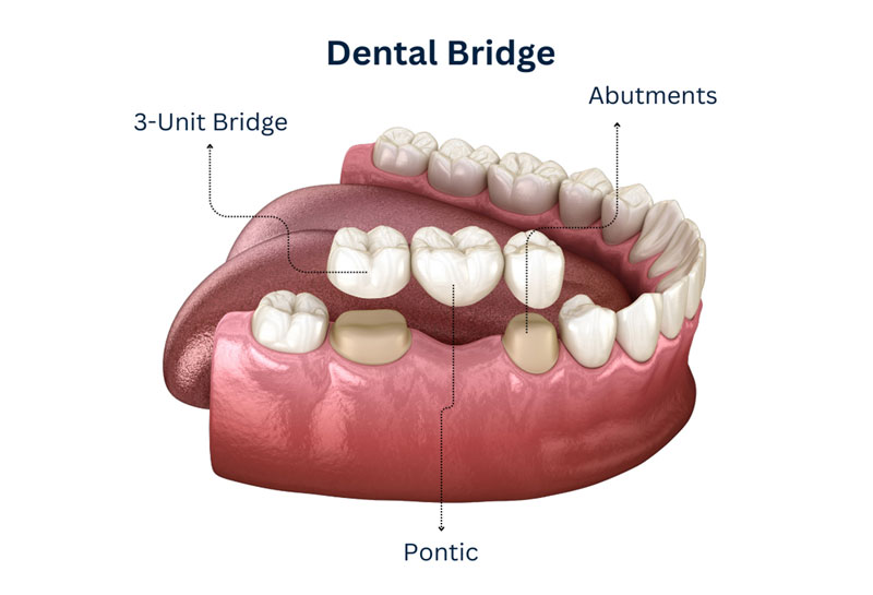 dental bridges