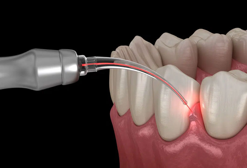 laser-dentistry