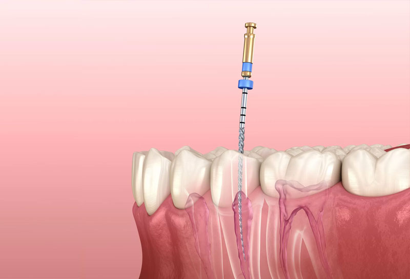 root canal